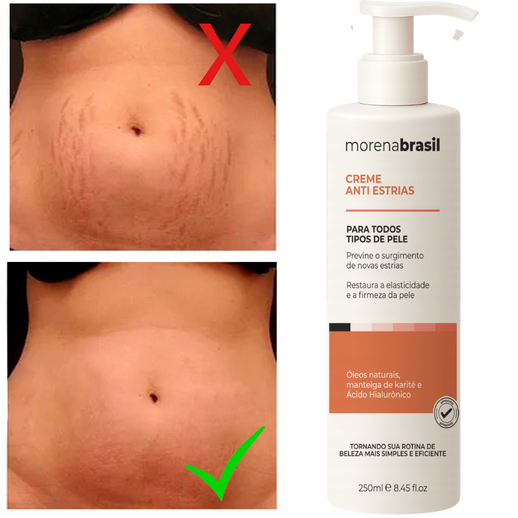 Creme Anti-Estrias - Diga Adeus às Estrias! Previne Novas Estrias & Reforça a Elasticidade Da Pele – foto na Shopee Brasil